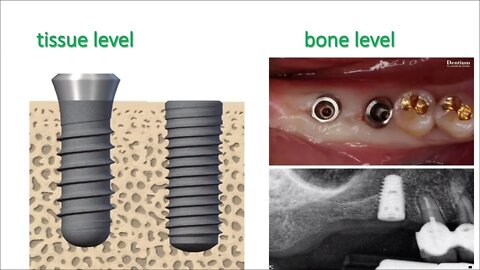 Oral Surgery L7 Part2 (Dental Implantology)