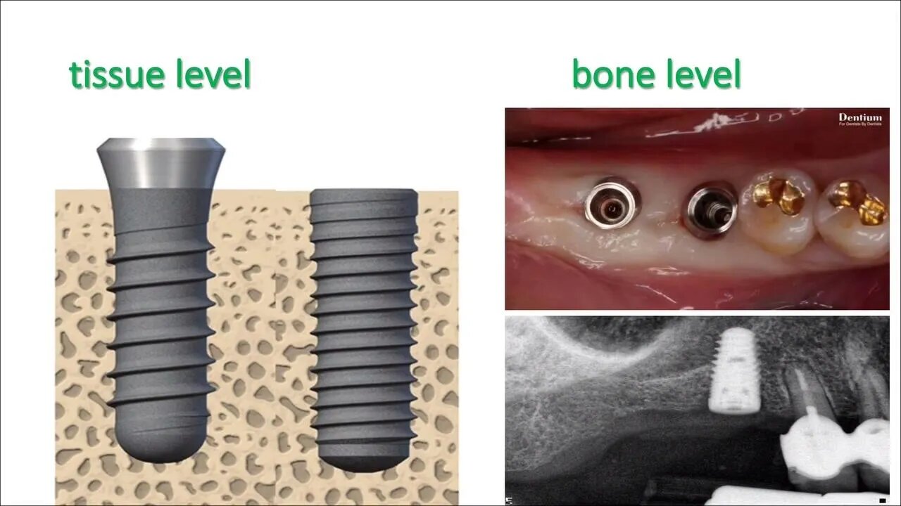 Oral Surgery L7 Part2 (Dental Implantology)