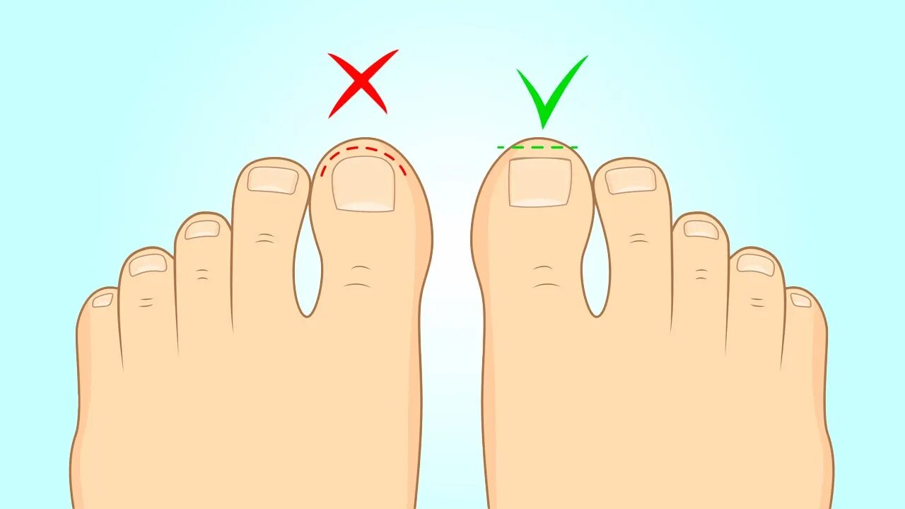 How to Fix Ingrown Toenails Fast at Home