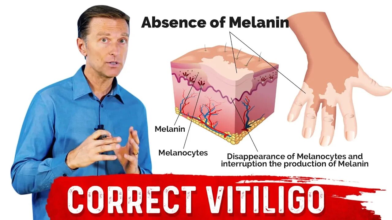 Fix Vitiligo With Copper