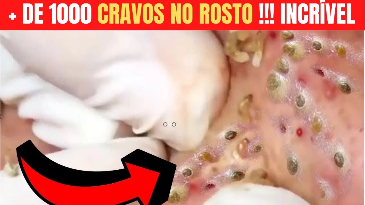 ESPREMENDO CRAVOS E ESPINHAS GIGANTESCAS Removendo Cravos e Espinhas do Rosto PIMPLE EXTRACTION