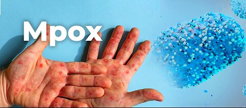 [ops] RADIOACTIVITY makes laboratory made Mpox infection propaganda lie to look sound real