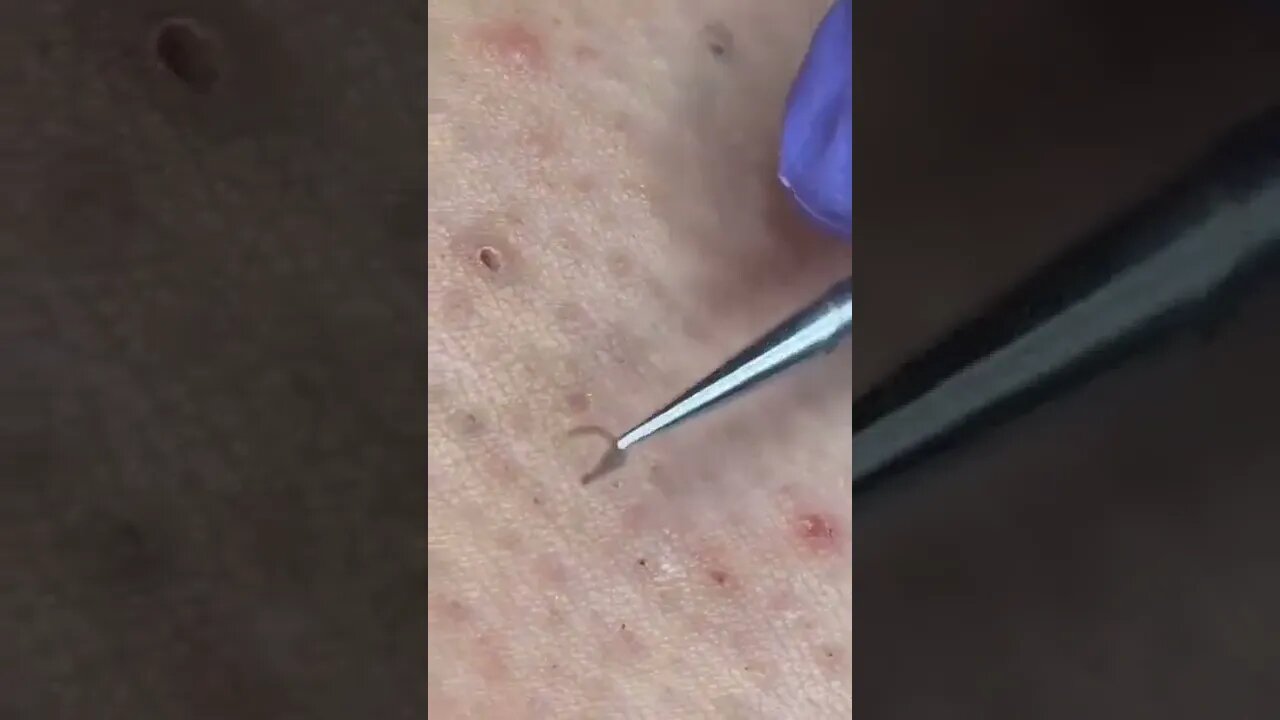 ZOOM Ingrown Hair Removal