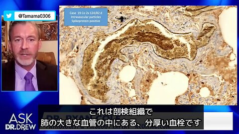 【コロワク】死者の剖検結果、スパイクタンパクの働きで大動脈破裂、癌