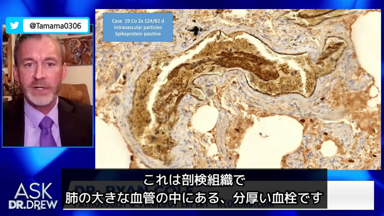 【コロワク】死者の剖検結果、スパイクタンパクの働きで大動脈破裂、癌