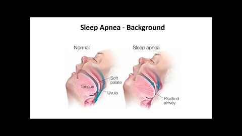 Sleep Apnea - Background