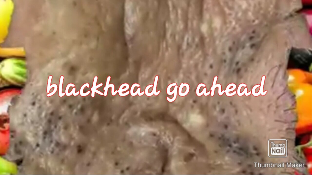 Blackhead removal satisfying video #3