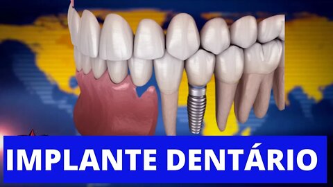 💥 NÃO FAÇA IMPLANTE DENTÁRIO SEM ANTES VER ESSE VÍDEO!