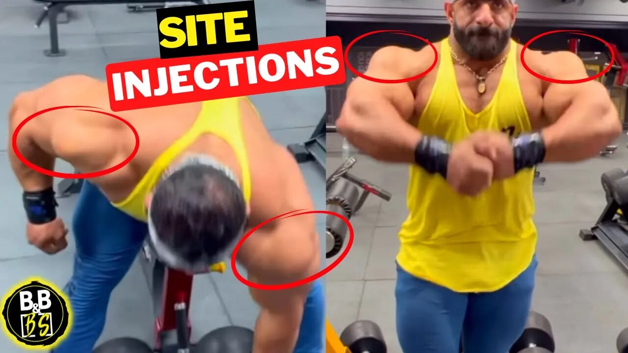 Hadi Choopan Ruined His Delts with Injections