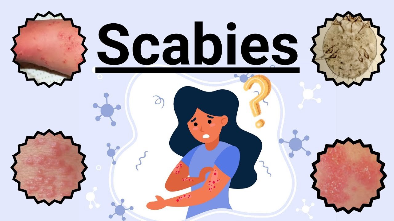 Scabies: Signs, Symptoms, Causes, Prevention and Treatment| Novice Medic