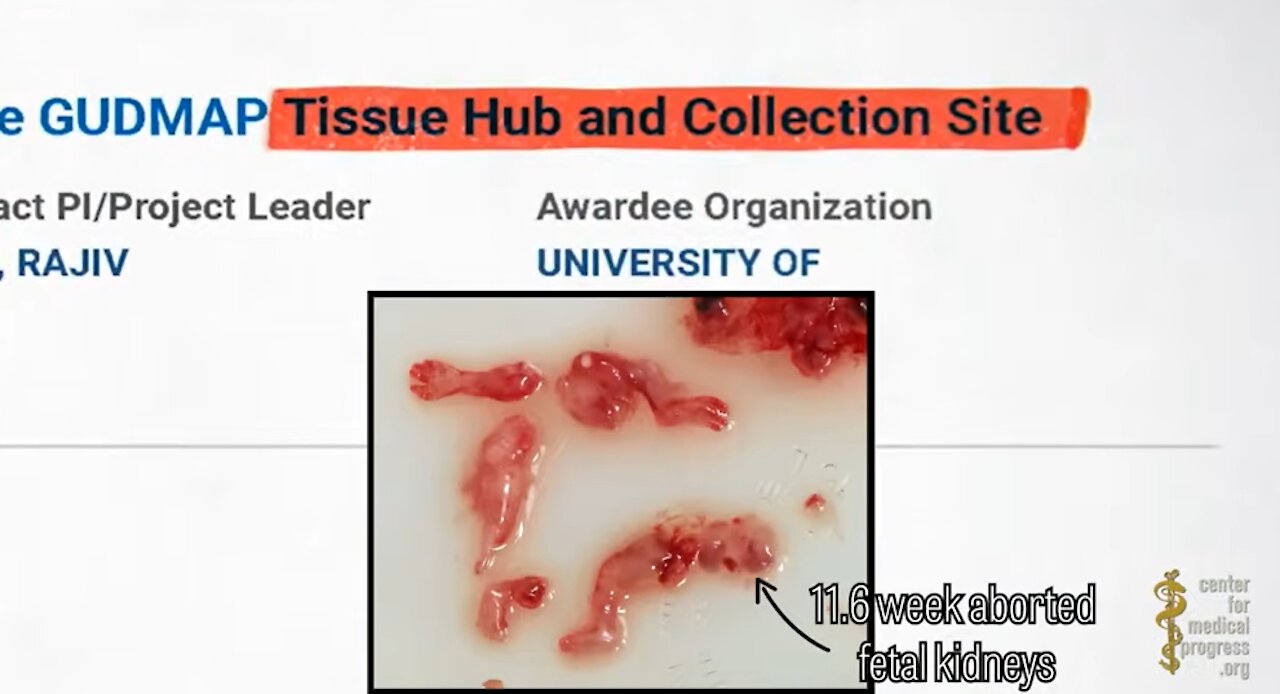 YOU CANNOT UNSEE THIS! Aborted babies, organ harvesting, fetal cells...IT'S ALL TRUE!