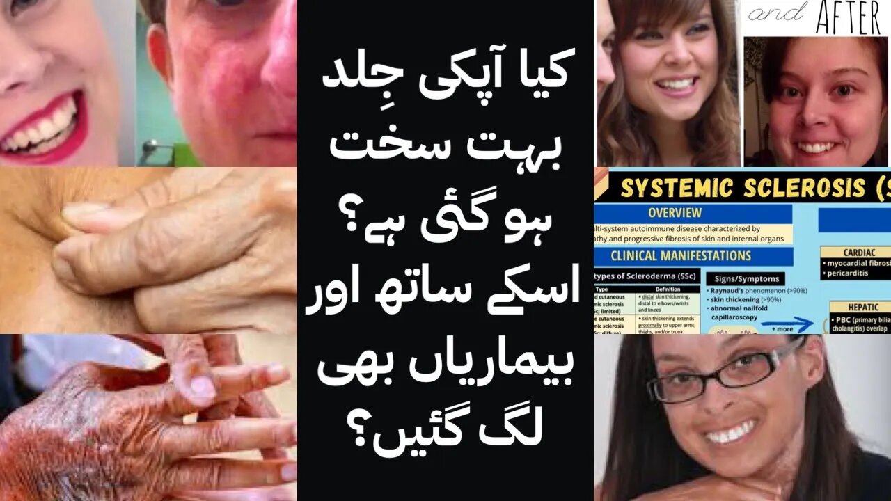 Scleroderma in Urdu