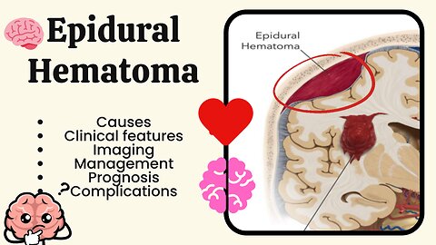 Epidural Hemorrhage Explained: Causes, Symptoms, Diagnosis, and Treatment