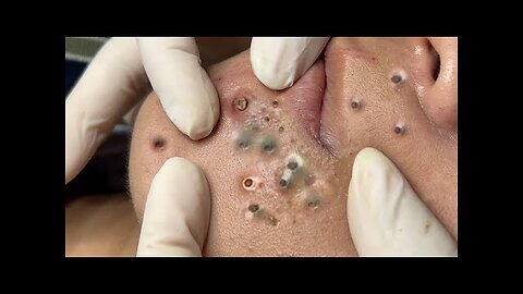 Satisfying blackhead removal, relaxing Pimple Popper 54327