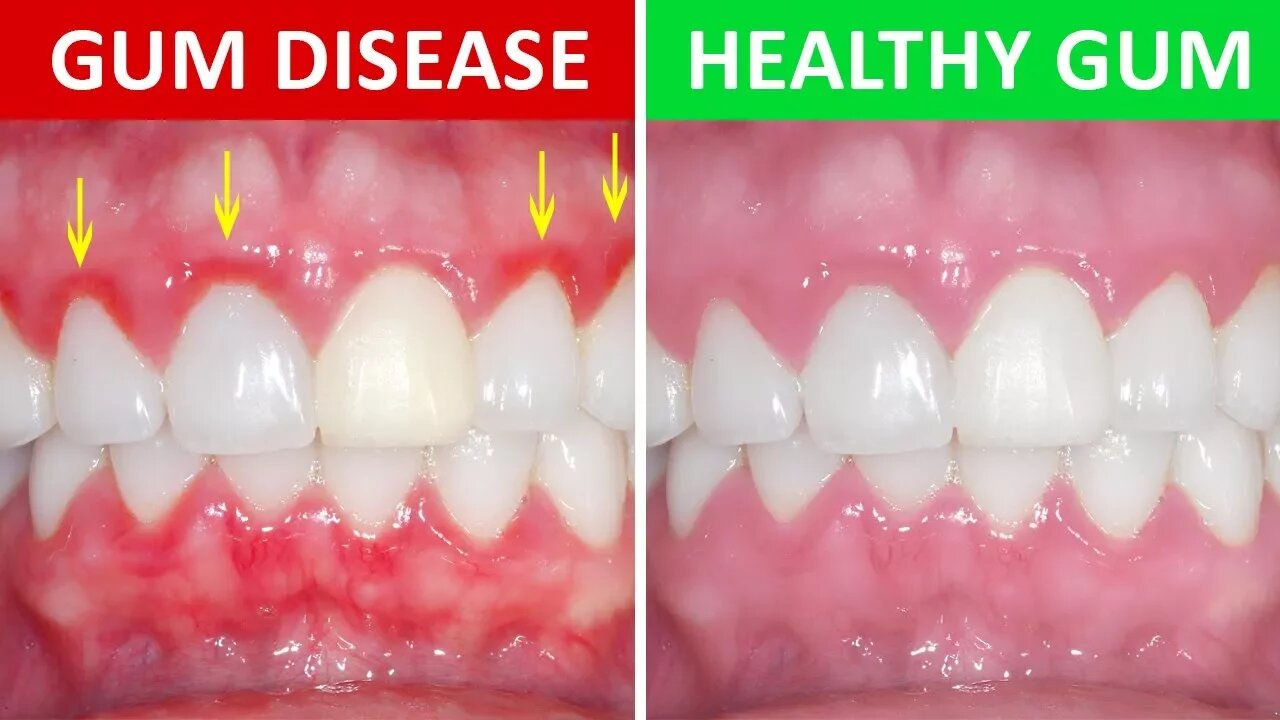 How to Get Rid of Gingivitis at Home (Gum Disease)