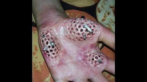 My Trypophobia infection