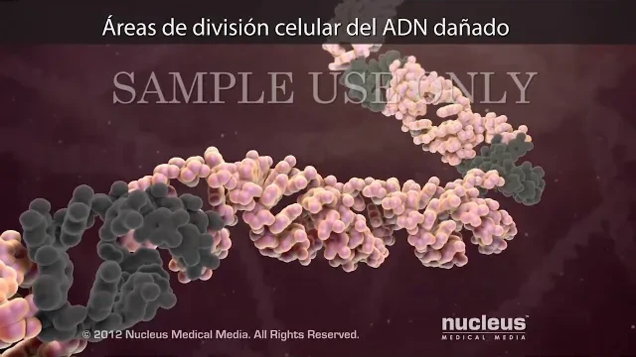 Radioterapia de intensidad modulada (RIM)