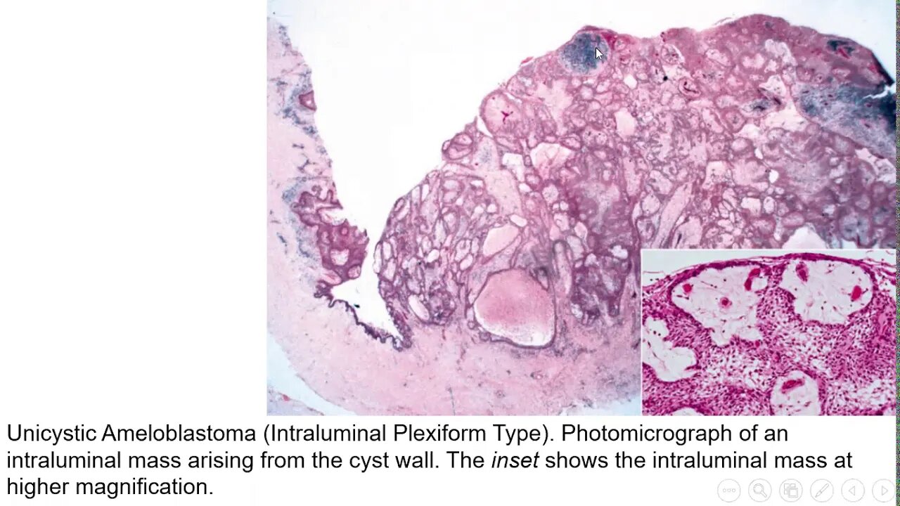 oral pathology L8 part2 (odontogenic tumors)