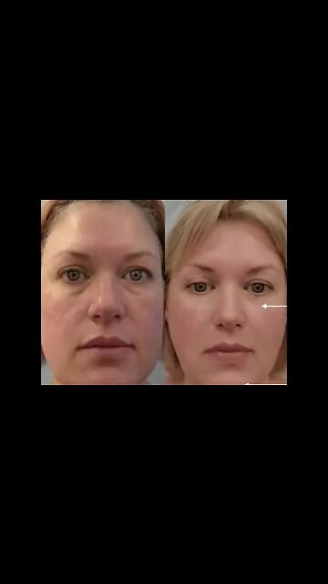 90 SECOND ALL-NATURAL FACELIFT LAUNCH: Z3.Skin is NOW Available! http://Z3.Skin by Essanté Organics