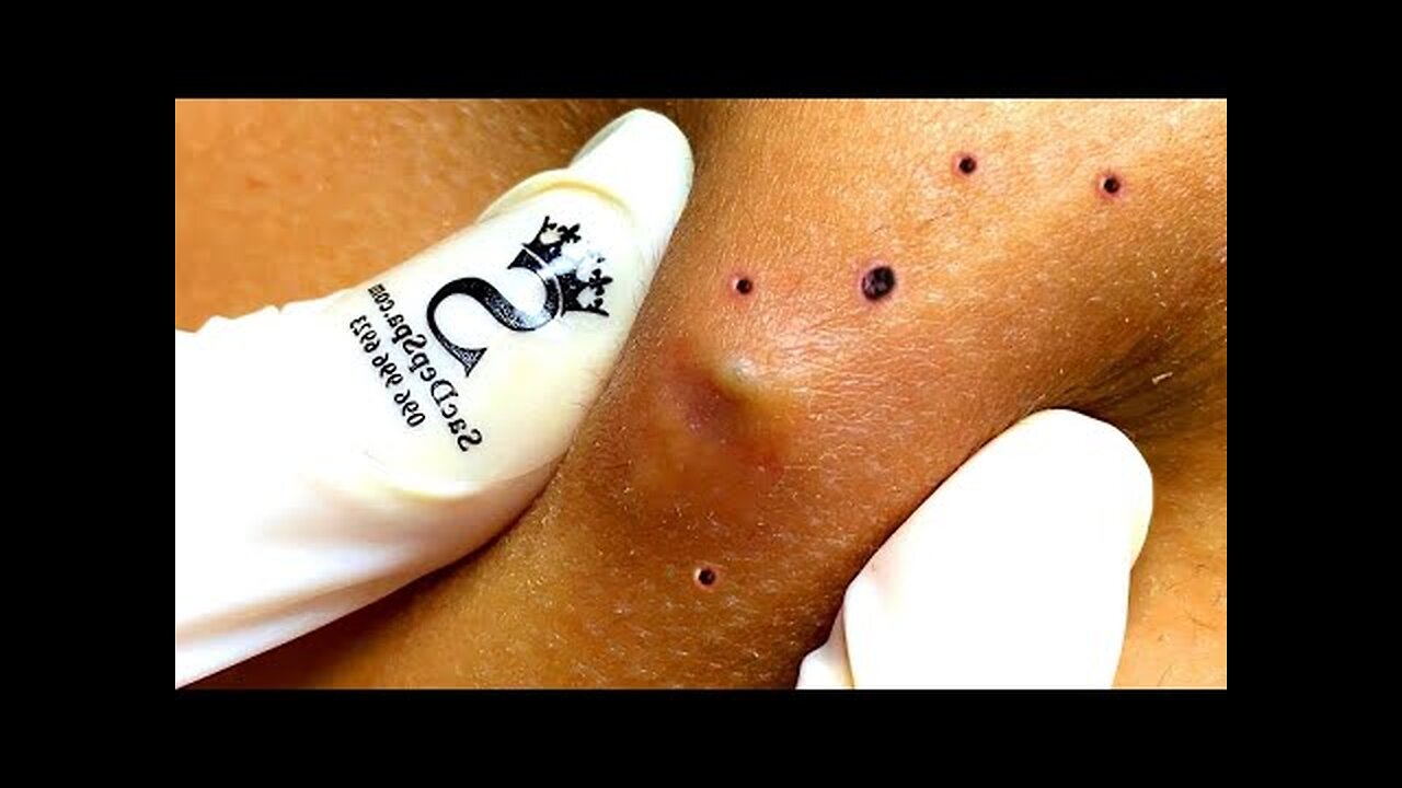 best blackhead removal cystic acne whitehead removal on face pimple popper how to skincare