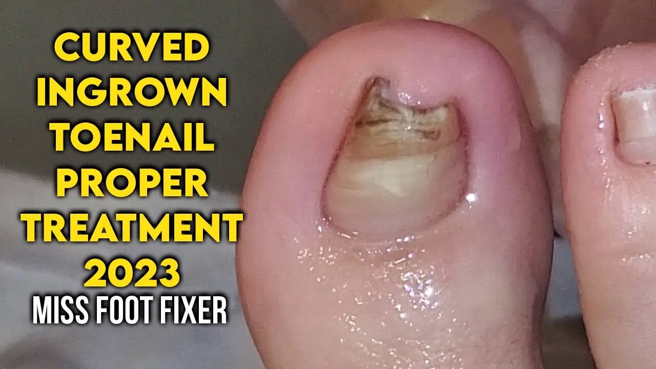 CURVED INGROWN TOENAIL PROPER TREATMENT BY FAMOUS PODIATRIST MISS FOOT FIXER 2023