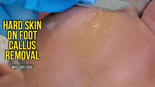 Satisfying hard skin on foot callus removal - Foot care callous treatment by miss foot fixer