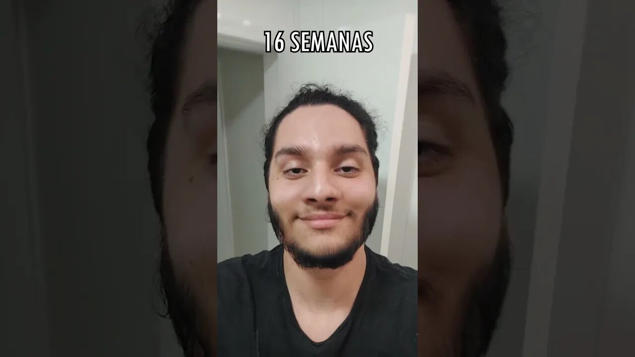 EVOLUÇÃO 4 MESES USANDO MINOXIDIL