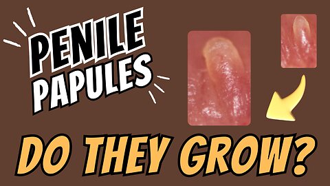 The Shocking Truth About Penile Papules Do They Really Grow 😱