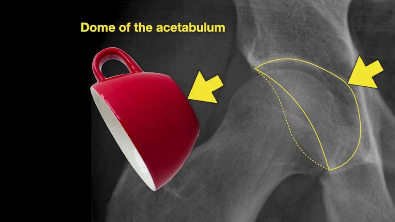 Anatomy of Hip X-rays