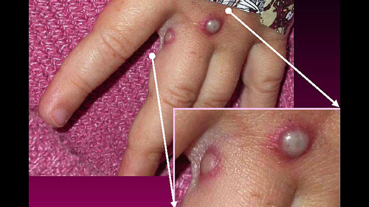 Two Cases Of Monkeypox Confirmed In Australia