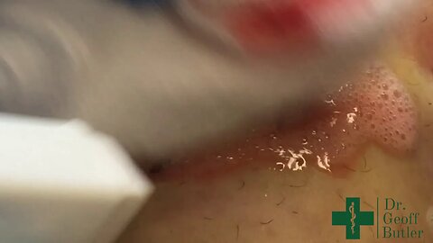 Opening of an infected Incision and secondary repair
