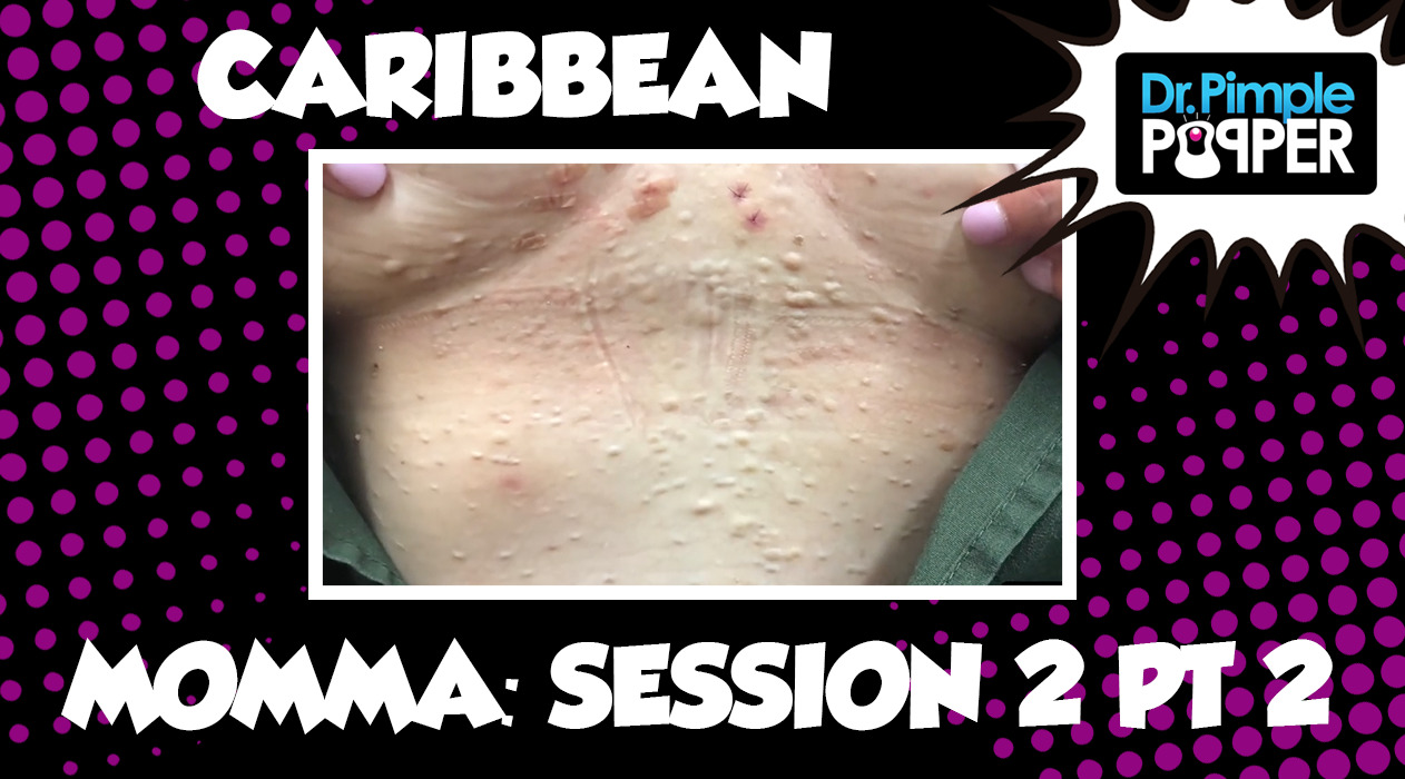 Caribbean Momma Steatocystomas: Session Two, Part Two