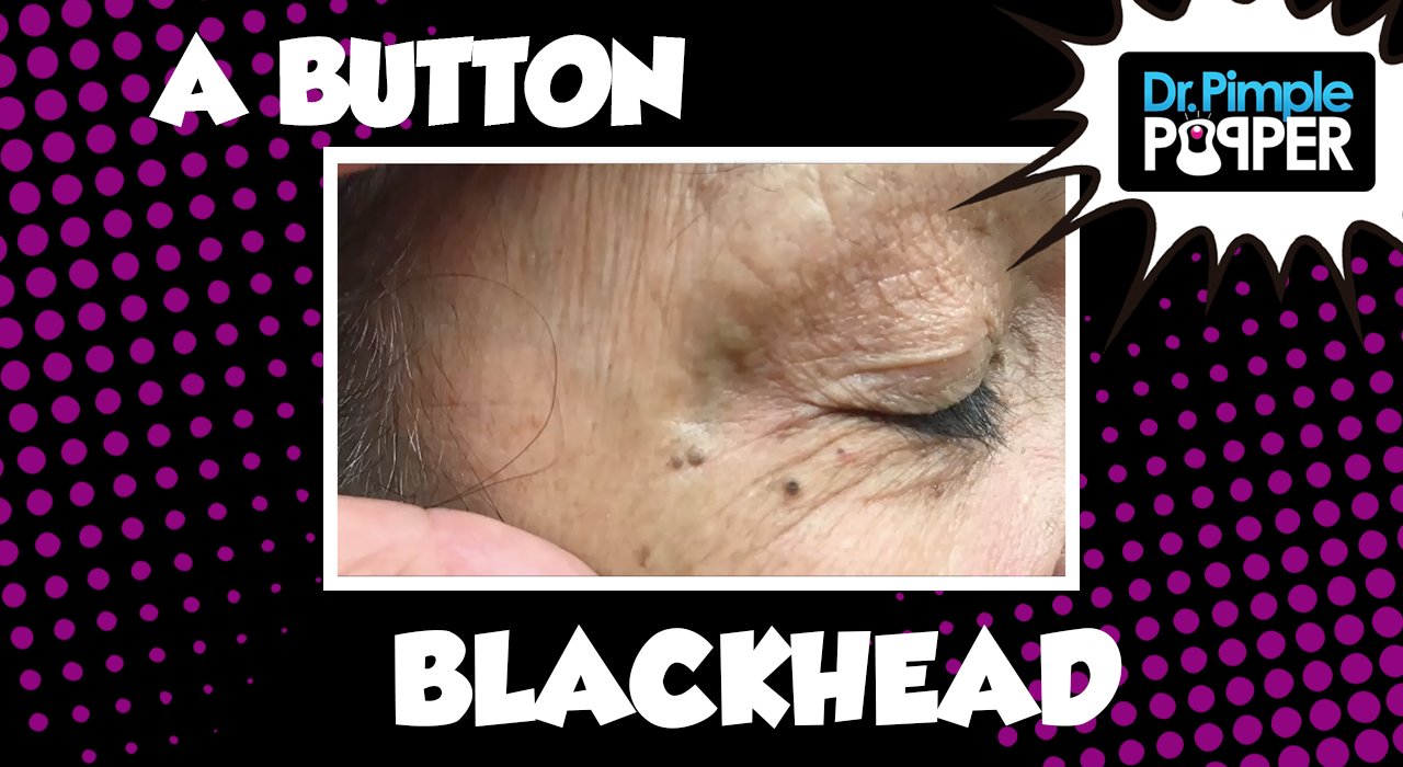 A Tiny Button Blackhead