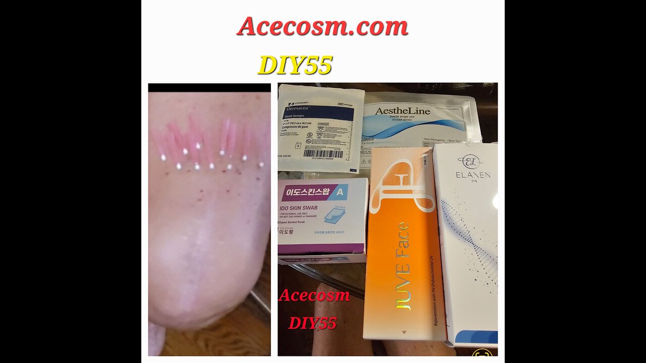 Knees legs Rejuvenation PDO threads Elaxen pn Juve Face Acecosm.com DIY55