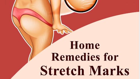 Home Remedies for Stretch Marks