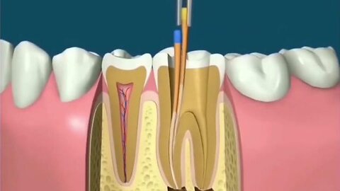 Cancer And Gum Disease - How Dentists Increase Our Risk Of Cancer