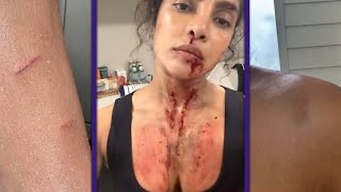 Priyanka Chopra Shows OfF REAL BATTLE SCARS While Filming Action Movie
