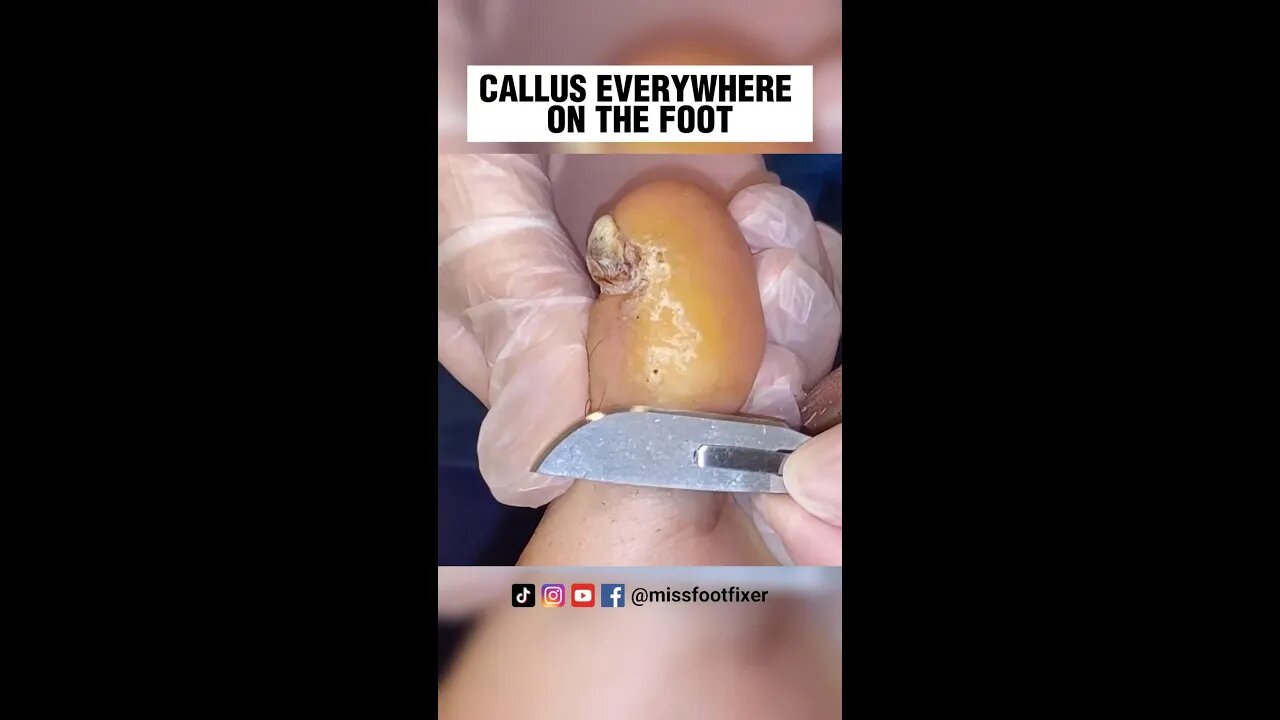 CALLUS EVERYWHERE ON FOOT 2023 [ NEVER ENDING CALLUS SCRAPING ] BY FOOT SPECIALIST MISS FOOT FIXER