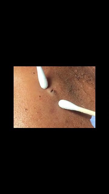 dr pimple popper