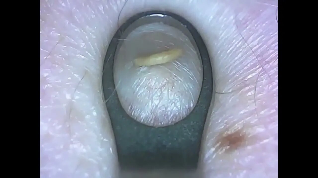 Oddly Satisfying Videos, BEST Acne, Blackheads. Whiteheads Removal, Squeezing Pimple, Tartar Removal