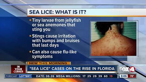 Sea lice reported along Florida beaches