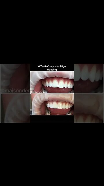 Dental And Teeth Hygiene