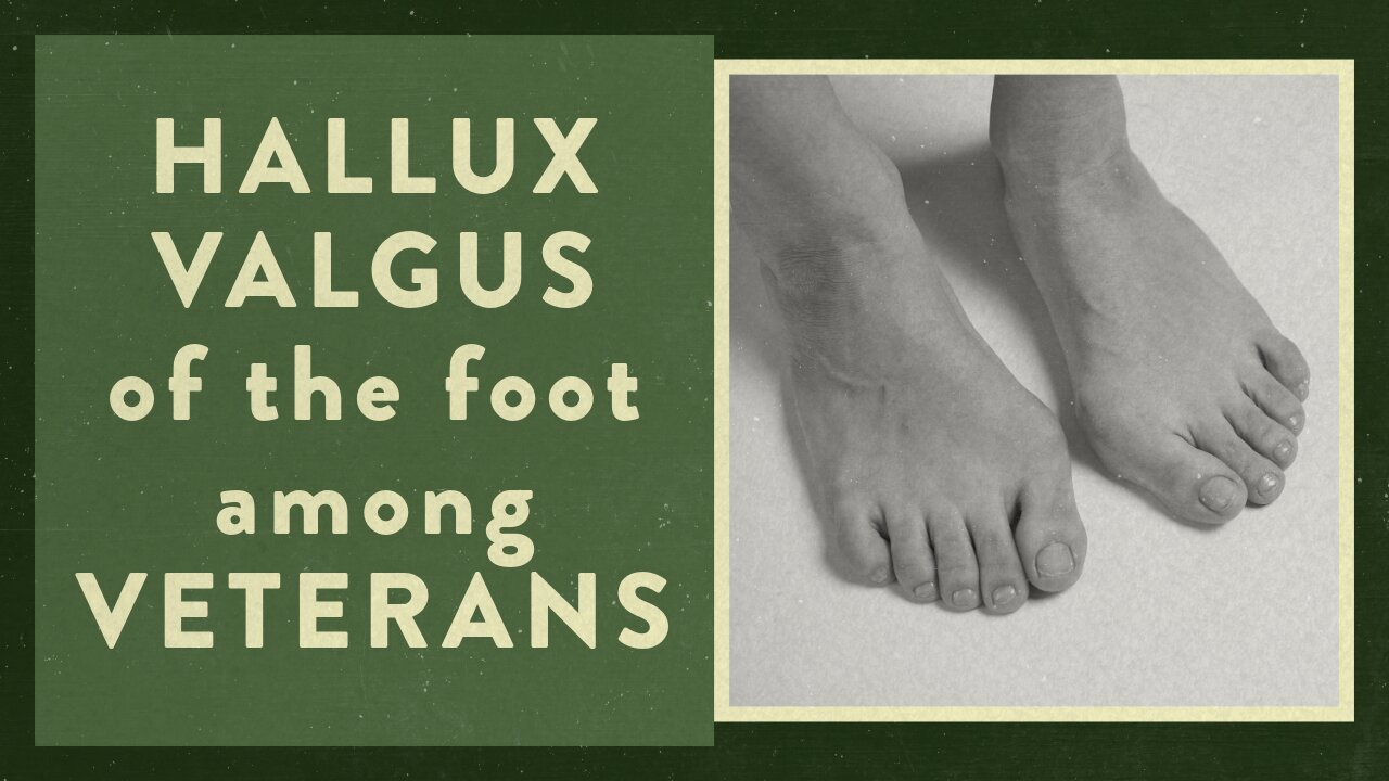 Hallux valgus of the foot among Veterans