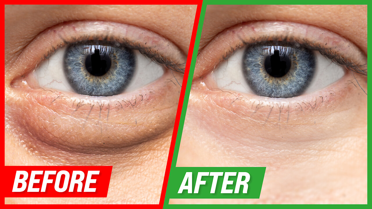 How to Get Rid of Puffy Eyes and Dark Circles