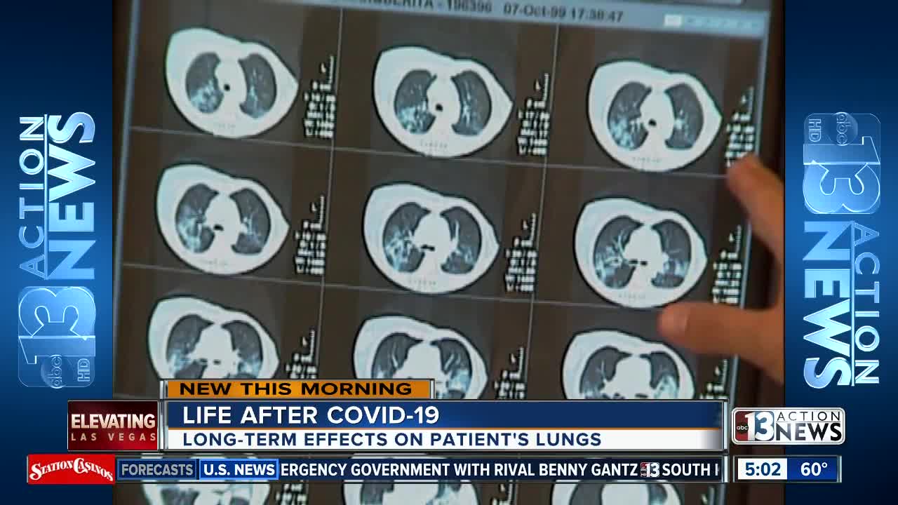Las Vegas pulmonologist prepares for wave of patients in recovery