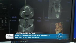 Affordable Dental Implants Are Here! // ClearChoice