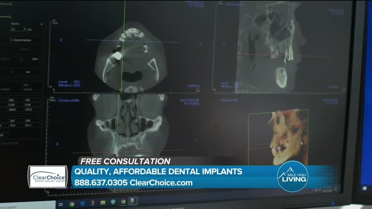 Affordable Dental Implants Are Here! // ClearChoice