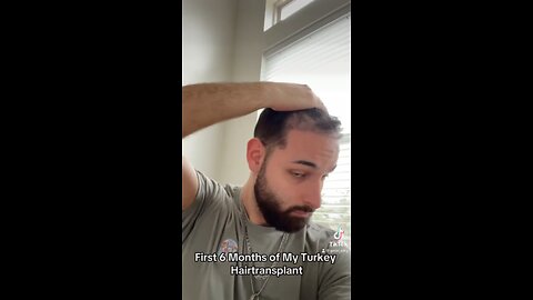 First Six Months Of My Turkey Hair Transplant