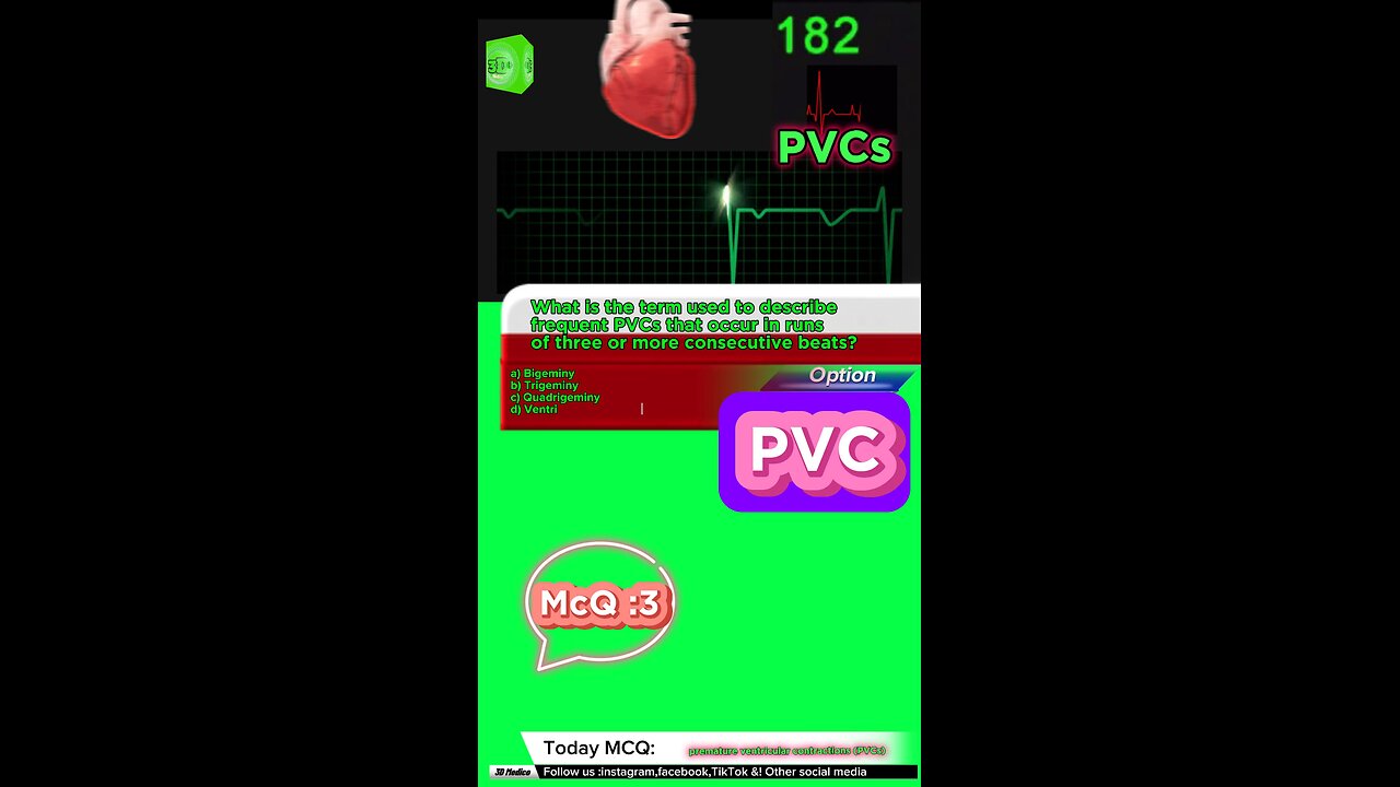 PVC #pvc #arrthymias #cardaic #heart prematureventricle tachycardia