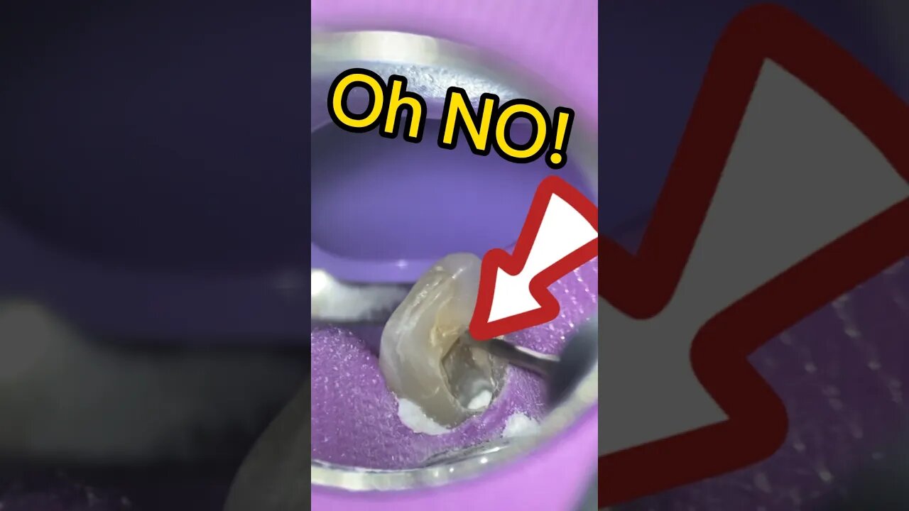 Has Your APEX Locator Done THIS? #dentist